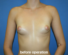 plastic-surgery-breast-augmentation